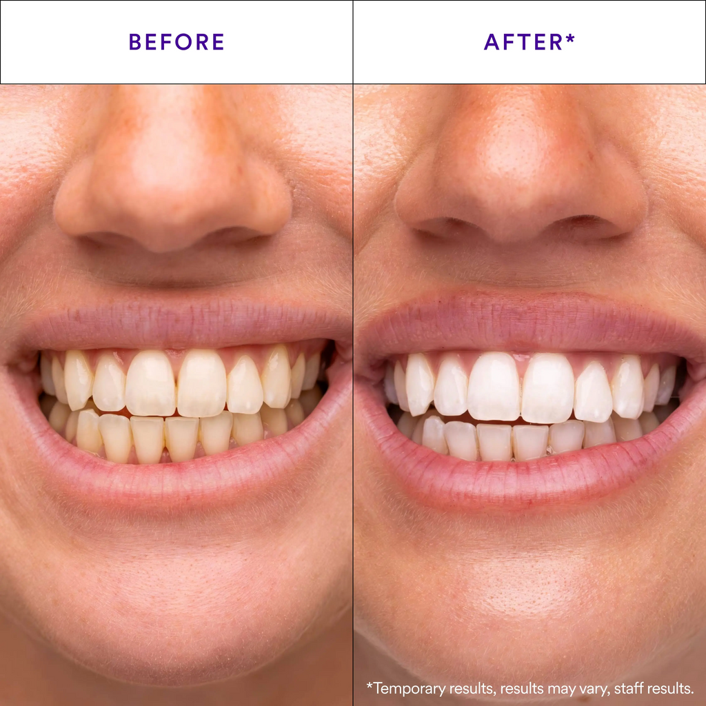 Hismile V34 Teeth Whitening Strips – 14 Applications