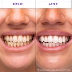 Hismile V34 Teeth Whitening Strips – 14 Applications