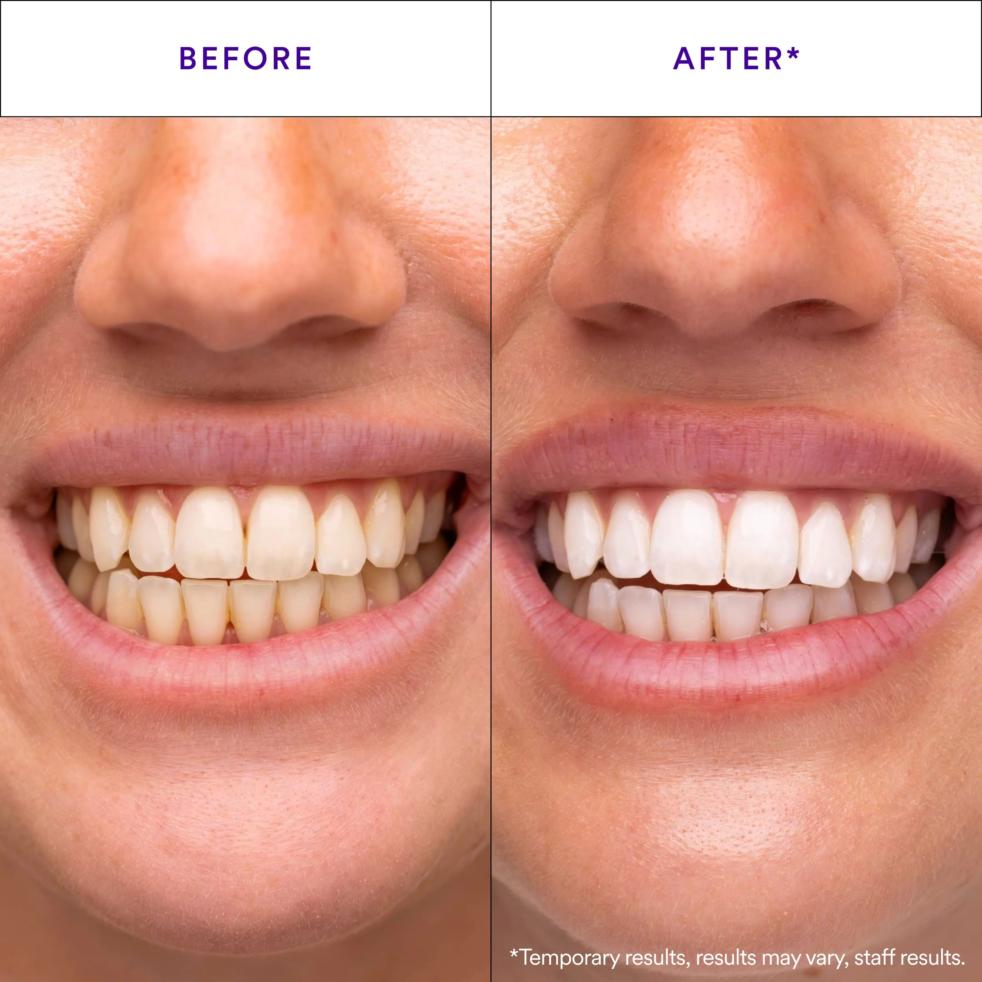 Hismile V34 Teeth Whitening Strips – 14 Applications