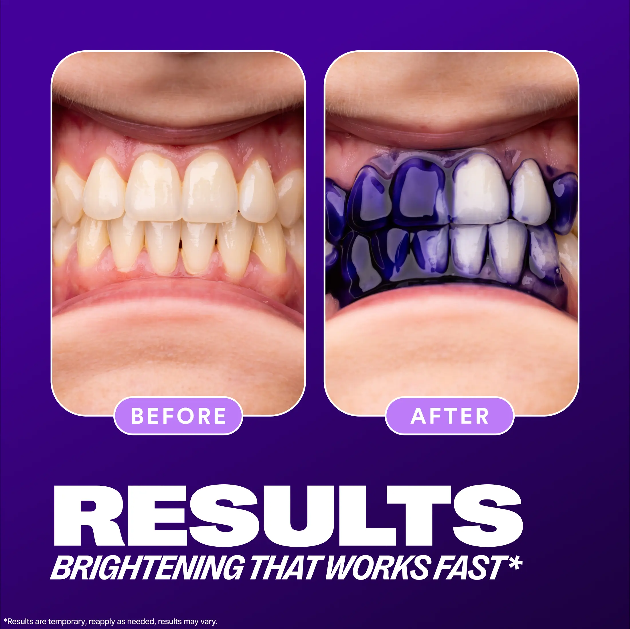 Hismile V34 Colour Corrector Serum – Instant Teeth Brightener